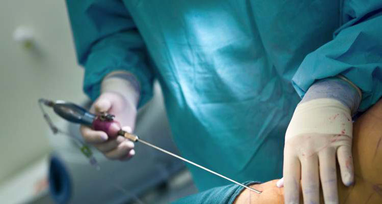 ¿Pasaron de moda los implantes de glúteos?